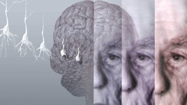 Alzheimer pode ser prevenido com exercício físico, aponta estudo